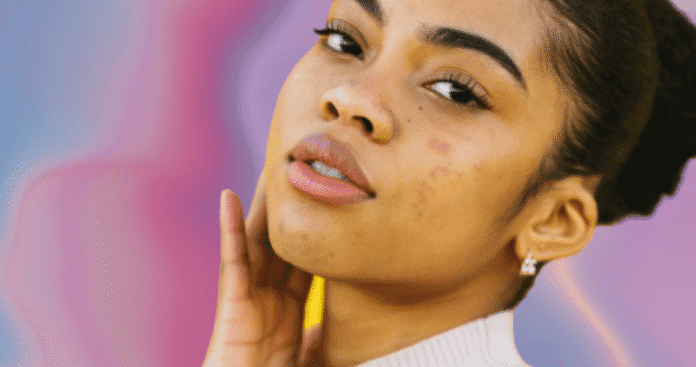 Back-to-school breakouts? A derm shares how to tackle acne with WM - Tag Template